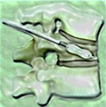 ЧТо такое баллонная кифопластика ЧТо такое баллонная кифопластика