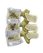 Что такое вертебропластика Что такое вертебропластика