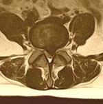 Виды грыж межпозвонковых дисков Виды грыж межпозвонковых дисков