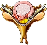 Секвестрированная грыжа межпозвонкового диска Секвестрированная грыжа межпозвонкового диска