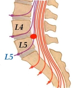 Грыжа диска L4-L5 Грыжа диска L4-L5
